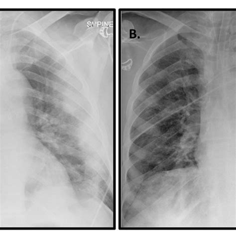 Chest Radiographs Of Patient 1 Download Scientific Diagram