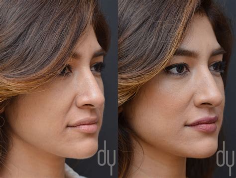 Before And After Treating Nasolabial Fold Smile Lines With Juvederm