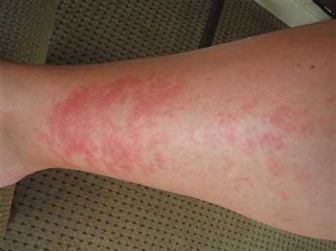 Weird Rash On My Leg
