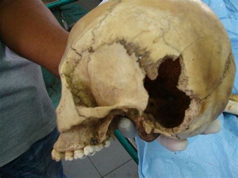 An introduction to forensic pathology is in the forensic pathology article. Exit through the Skull | Forensic Pathology Online