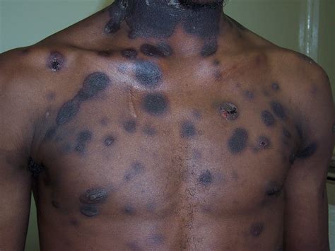 Introduction steven johnson syndrome (sjs) is a disorder of the skin and mucous membrane, induced by exposure to drugs or infections. Steven's Johnson Syndrome | Flickr - Photo Sharing!