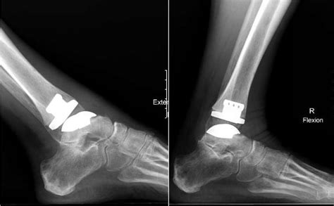 Total Ankle Arthroplasty Offers Patients Greater Range Of Motion And