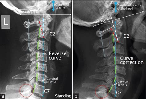 Cervical Spine Lateral View Of Case 2 A Prior To Treatment Lateral