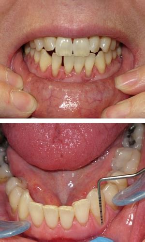 Hold the floss tightly between the thumb and. Avoid gum recession and maintain gum height with proper ...