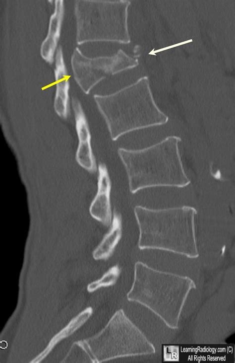 Burst Fracture Of Lumbar Spine Sagittal Reconstruction Of Ct Of The