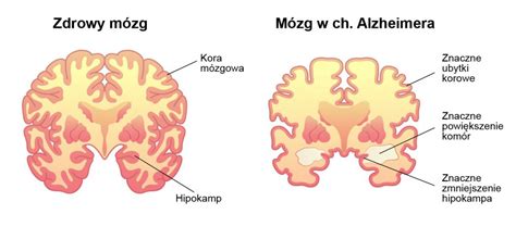 Choroba Alzheimera Przyczyny Objawy Diagnoza I Leczenie Bj Medical