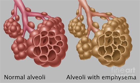 Normal Vs Emphysematous Alveoli Photograph By Gwen Shockey Fine Art