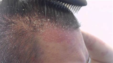 Scalp Psoriasis Hair Loss Pictures Photos