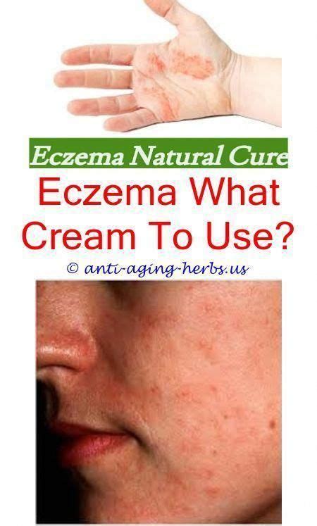 Nummular Eczema Treatment Over The Counter Severe Eczema Treatments