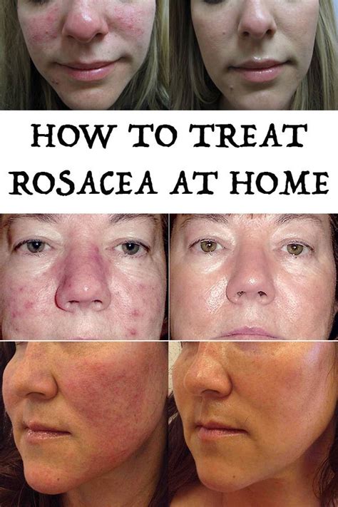 Beauty Enhancers How To Treat Rosacea At Home