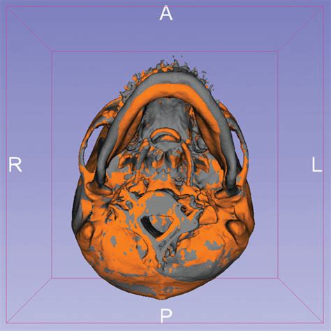 The 3d Imaging Of The Craniofacial Area Reconstructed With The Download Scientific Diagram