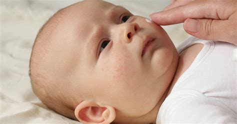 Baby Eczema Treatment 3 Different Approaches To Treating Baby Eczema