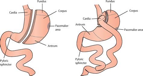 Adaptations In Gastrointestinal Physiology After Sleeve Gastrectomy And