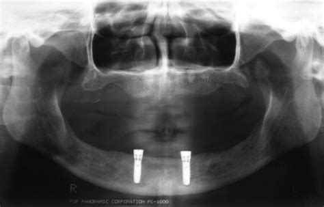Implant Overdenture Dallas Dental Implant Center