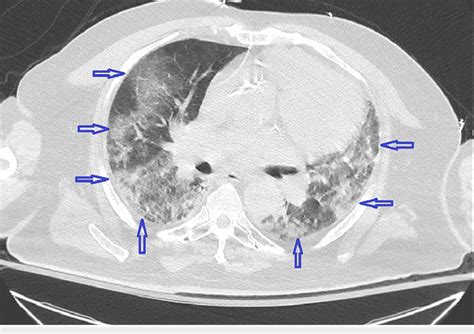 Ct Chest Without Contrast Cross Sectional View Demonstrating Diffuse