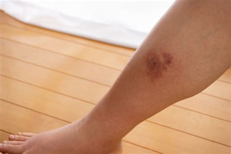 The Link Between Lymphedema And Cellulitis