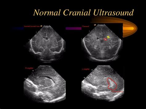 Ppt Ivh In Preterm Infants Powerpoint Presentation Id270071