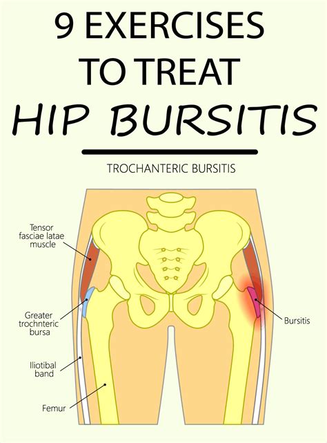 Exercises To Treat Hip Bursitis Bursitis Hip Bursitis Hip