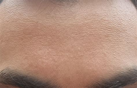 Skin Concern How Do I Improve The Texture Of My Forehead R