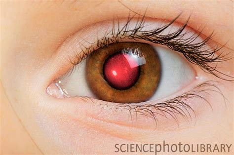 Pourquoi Mes Yeux Sont Rouges Sur Les Photos Curyeux Optometriste