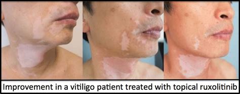 Treatment For Vitiligo Philadelphia Homeopathic Clinic Tsan And The Team