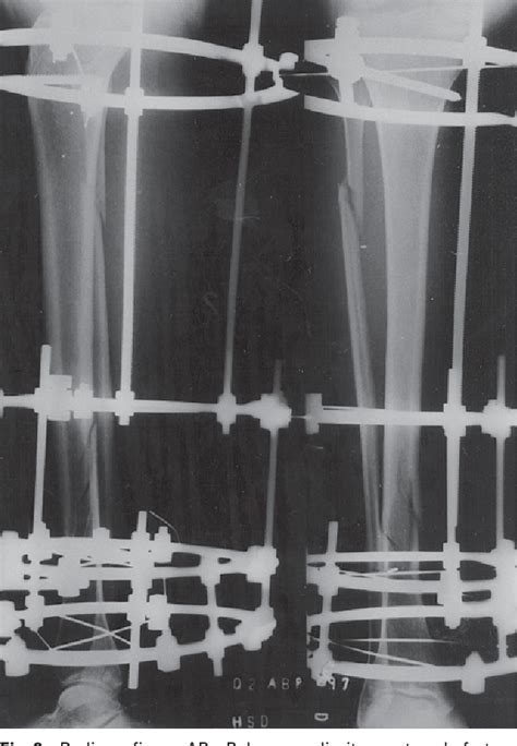 Figure 2 From Ilizarov External Fixator Pin Tract Osteomyelitis