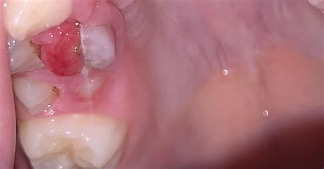 broken molar album on imgur