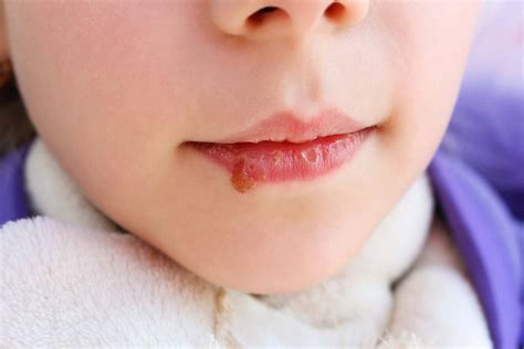 Oral Candidiasis In Children Symptoms Causes And Treatment You Are Mom