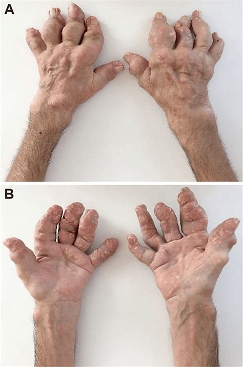 Gout Tophi On Fingers And Hands A Hands In Prone Posture B Hands Download Scientific
