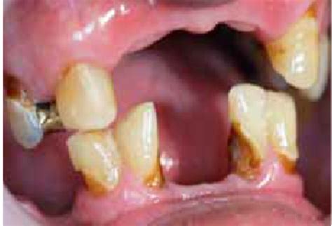 Poor Oral Hygiene And Root Caries In A Download Scientific Diagram