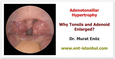 Tonsils And Adenoids