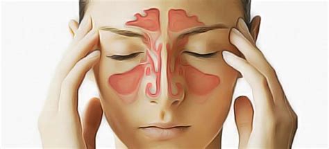 What's good to remove a bruise quickly? How to Get Rid of a Sinus Infection in 24 hours ...