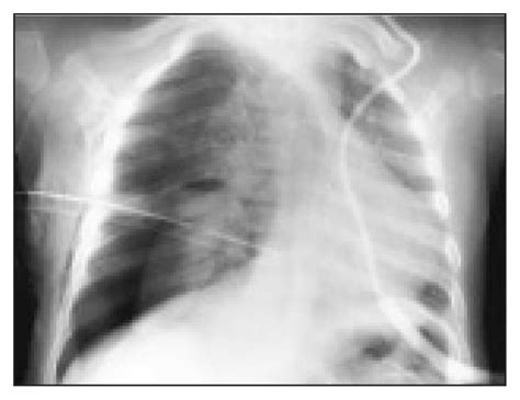 Pneumothorax Following Tube Thoracostomy And Water Seal Drainage Cjs