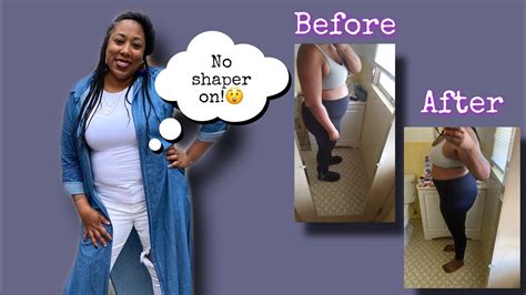 Smart Lipo With Sono Bello Before And After Pics Youtube