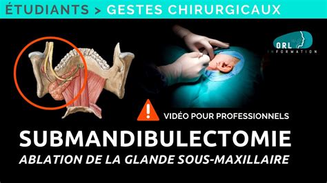 How To Perform A Submandibular Gland Resection Step By Step Procedure