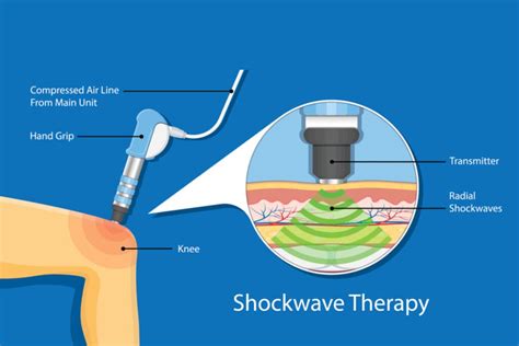 Shockwave Therapy Warsash Therapy Rooms