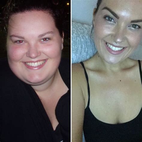 Woman Left With Belly Boobs After Losing 11 Stone And Fat Collected