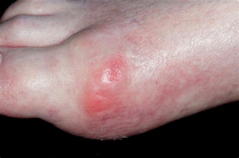 Gout Of The Big Toe Photograph By Dr P Marazziscience Photo Library