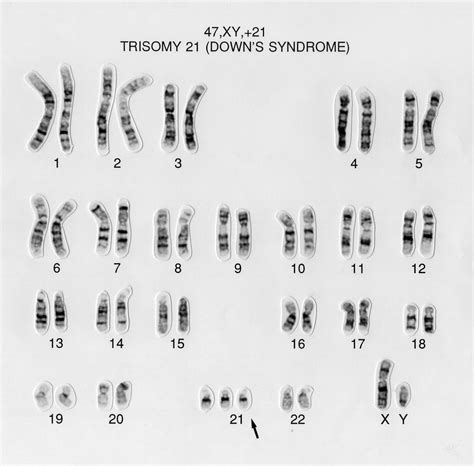 Down Syndrome Human Karyotype 47 XY 21 Wellcome Collection