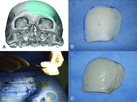 Surgical Procedure Of Patient Specific Pclß Tcp Implant Based