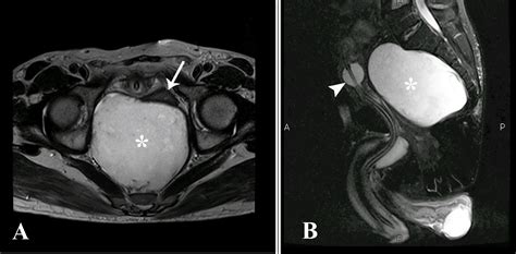 Cureus A Rare Case Of Presacral Epidermoid Cyst In An Adult Male