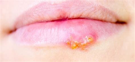 Oral herpes is an infection of the lips, mouth, or gums due to the herpes simplex virus. Pictures | Cold Sores