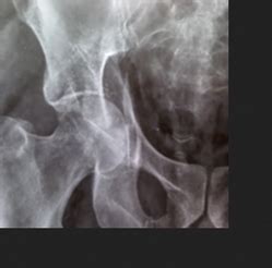 Fractures Treatment Service in Ahmedabad