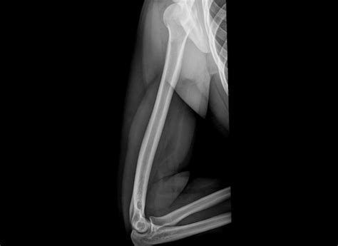 Radiograph of the left humerus shows an humeral fracture spiral midshaft. Humeral shaft fracture