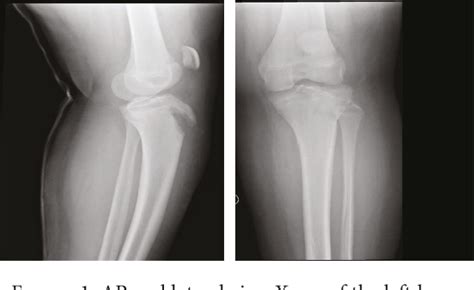 Figure 1 From Avulsion Fracture Of The Tibial Tuberosity Combined With