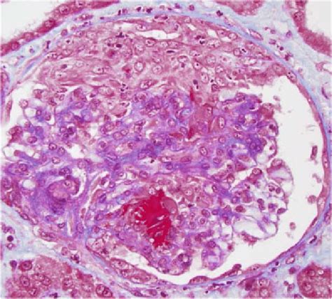 5 Glomerulus From A Patient With Microscopic Polyangiitis
