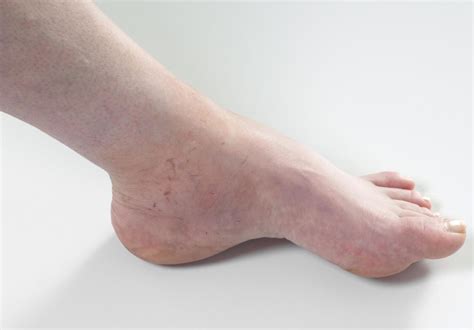 Cause Of Edema In Left Foot Forward Causes Of Swollen Feet And Ankles