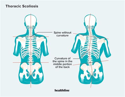 Thoracic Scoliosis Symptoms Causes Treatments And More