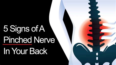 5 Signs Of A Pinched Nerve In Your Back Inspiring Life