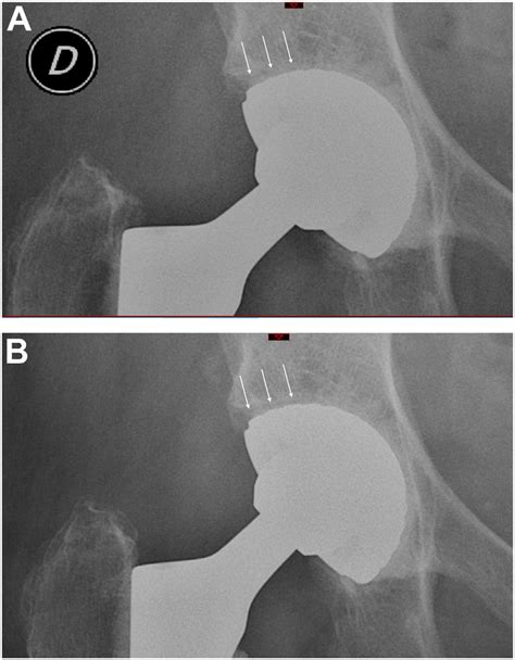 Anteroposterior Pelvis Radiograph Illustrating A Cemented Dual Mobility